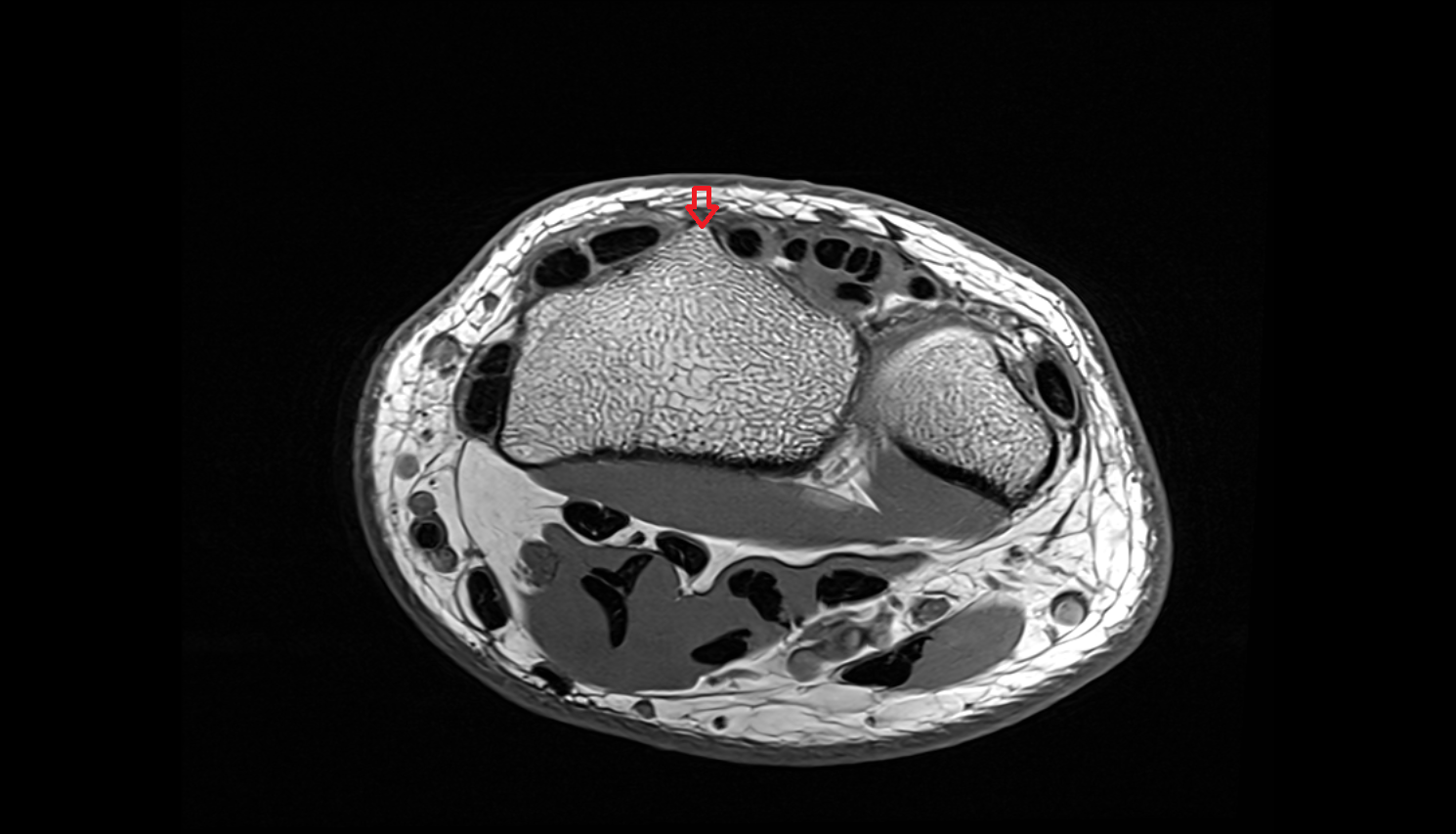 Dorsal radial tubercle (Lister’s tubercle) axial cross sectional anatomy 3T MRI AI enhanced radiology image-img-00000-00000