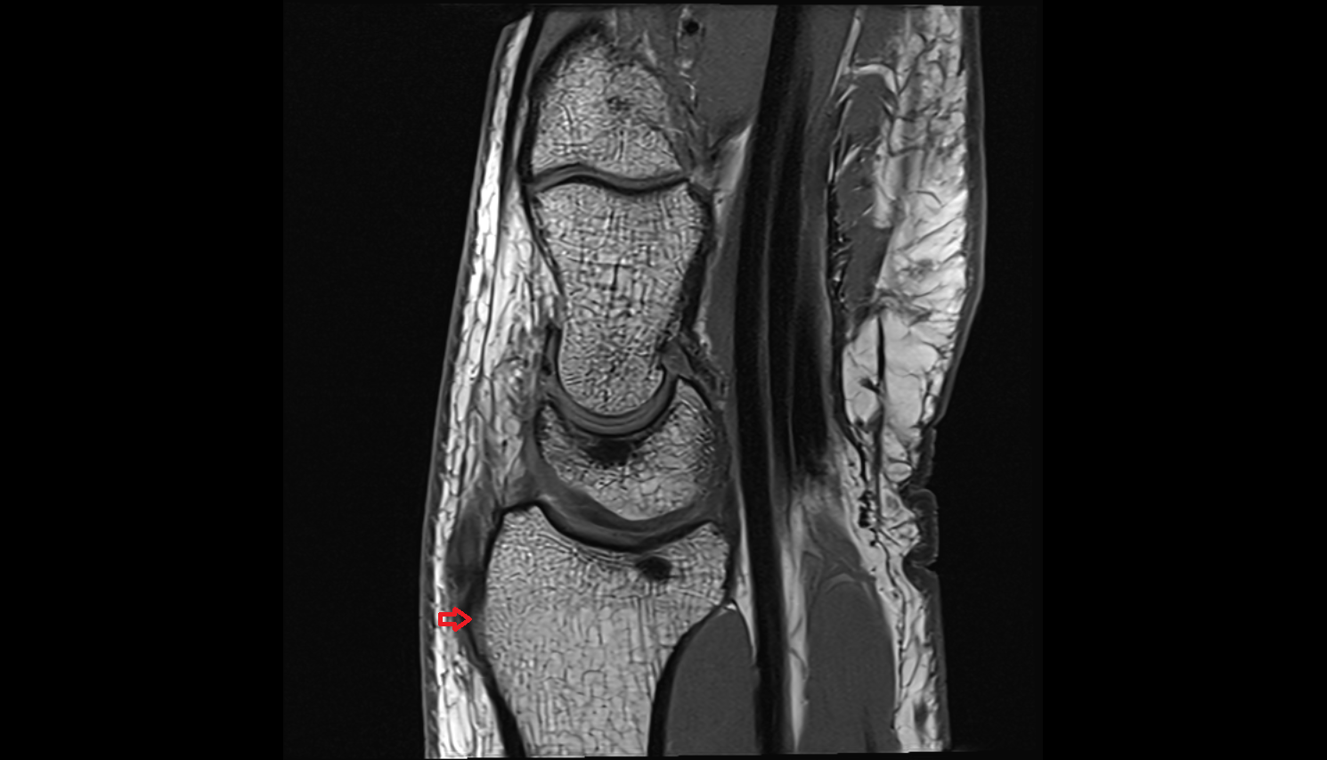 Dorsal radial tubercle (Lister’s tubercle) sag cross sectional anatomy 3T MRI AI enhanced radiology image-img-00000-00000_00001