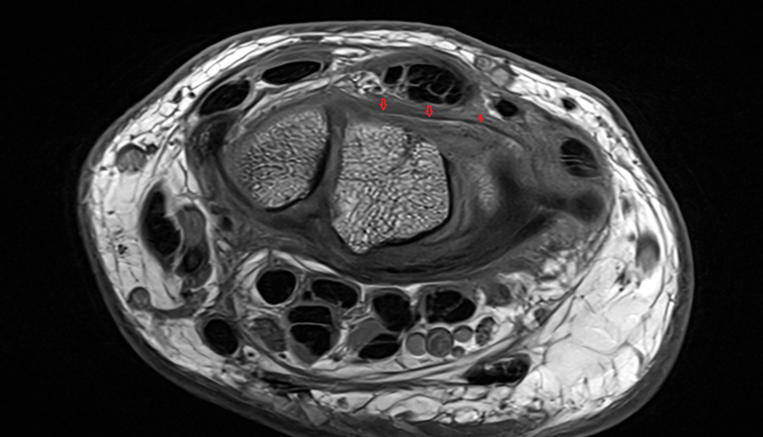 Dorsal radiocarpal ligament axial cross sectional anatomy 3T MRI AI enhanced radiology image-img-00000-00000