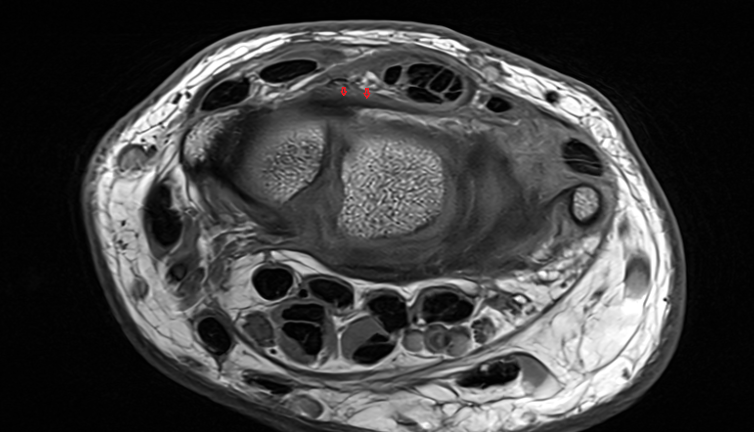 Dorsal radiocarpal ligament axial cross sectional anatomy 3T MRI AI enhanced radiology image-img-00000-00000_00001