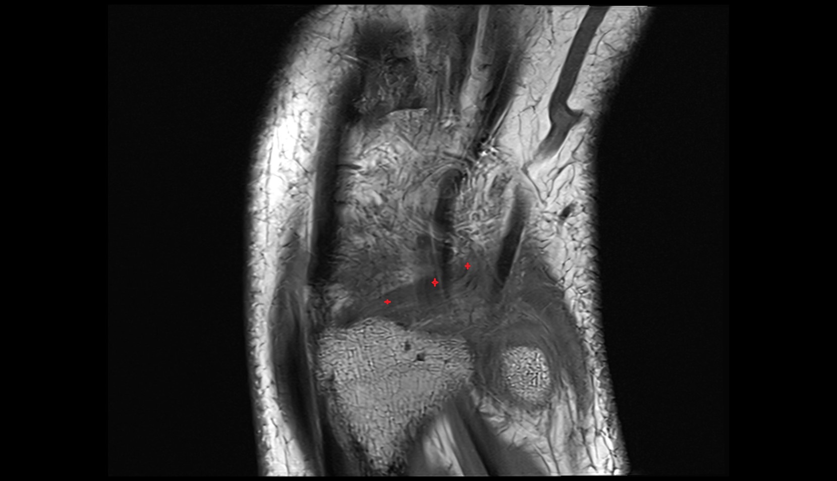 Dorsal radiocarpal ligament mri coronal image