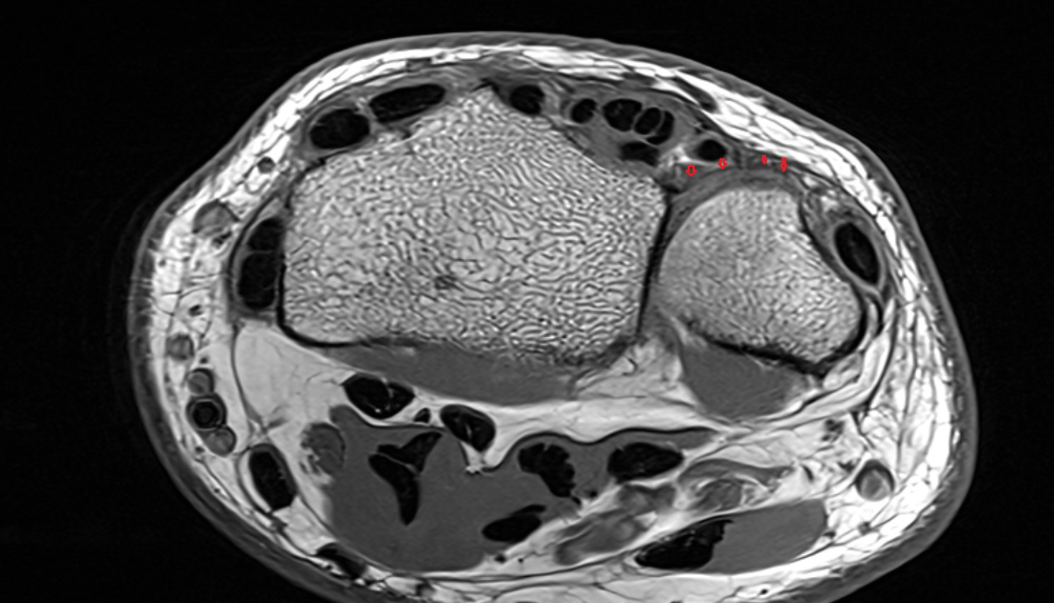Dorsal radioulnar ligament axial cross sectional anatomy 3T MRI AI enhanced radiology image-img-00000-00000