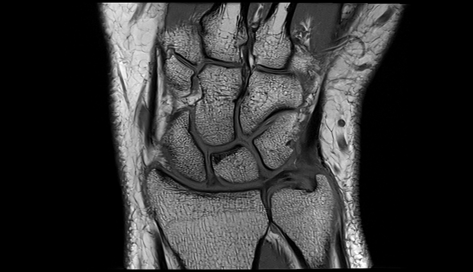 Dorsal radioulnar ligament mri coronal image