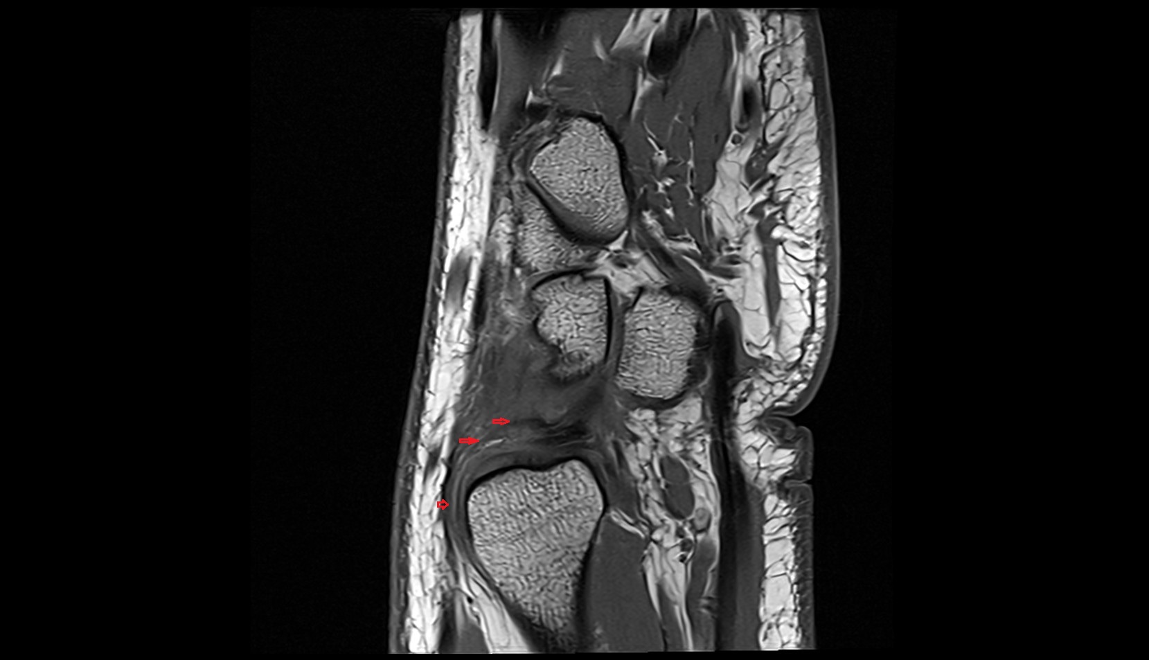 Dorsal radioulnar ligament mri sagittal image