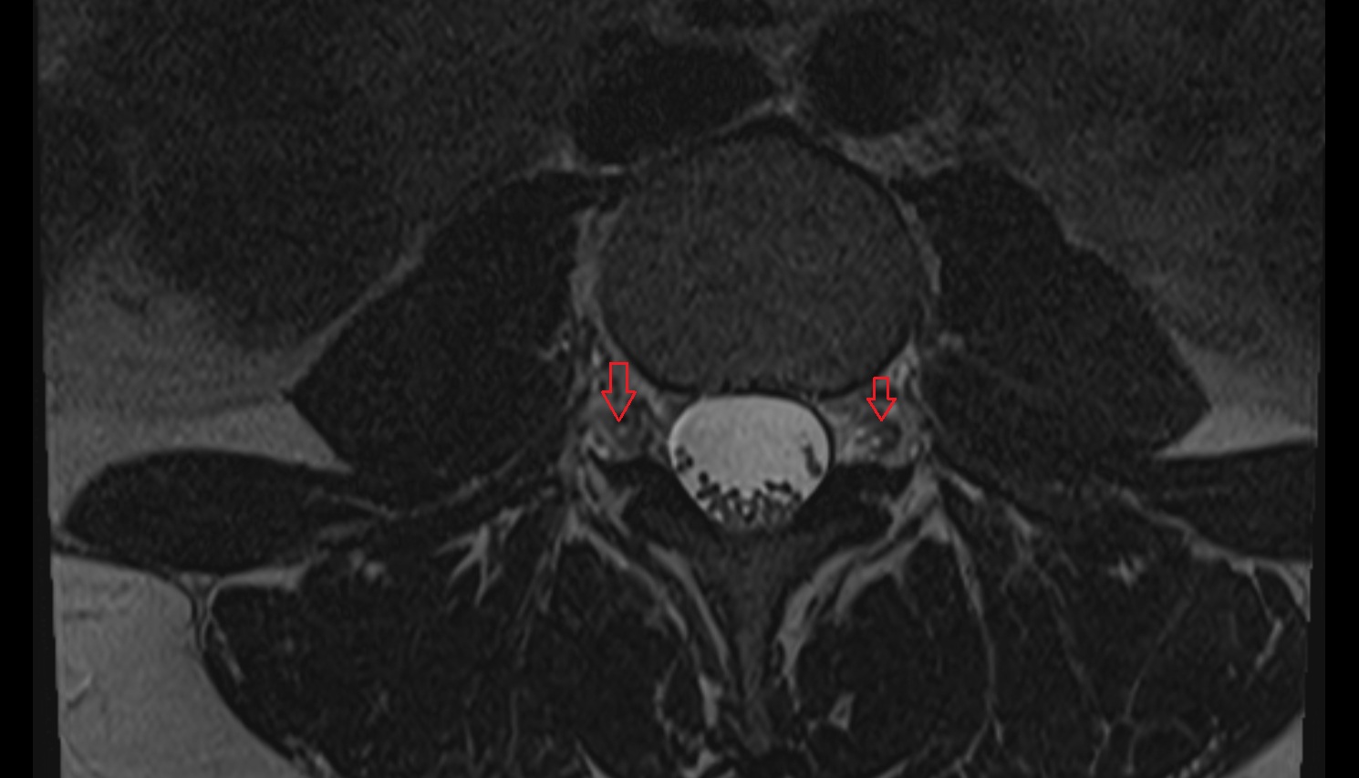 Dorsal root ganglion of spinal nerve  MRI axial  anatomy  image-img-00000-00000