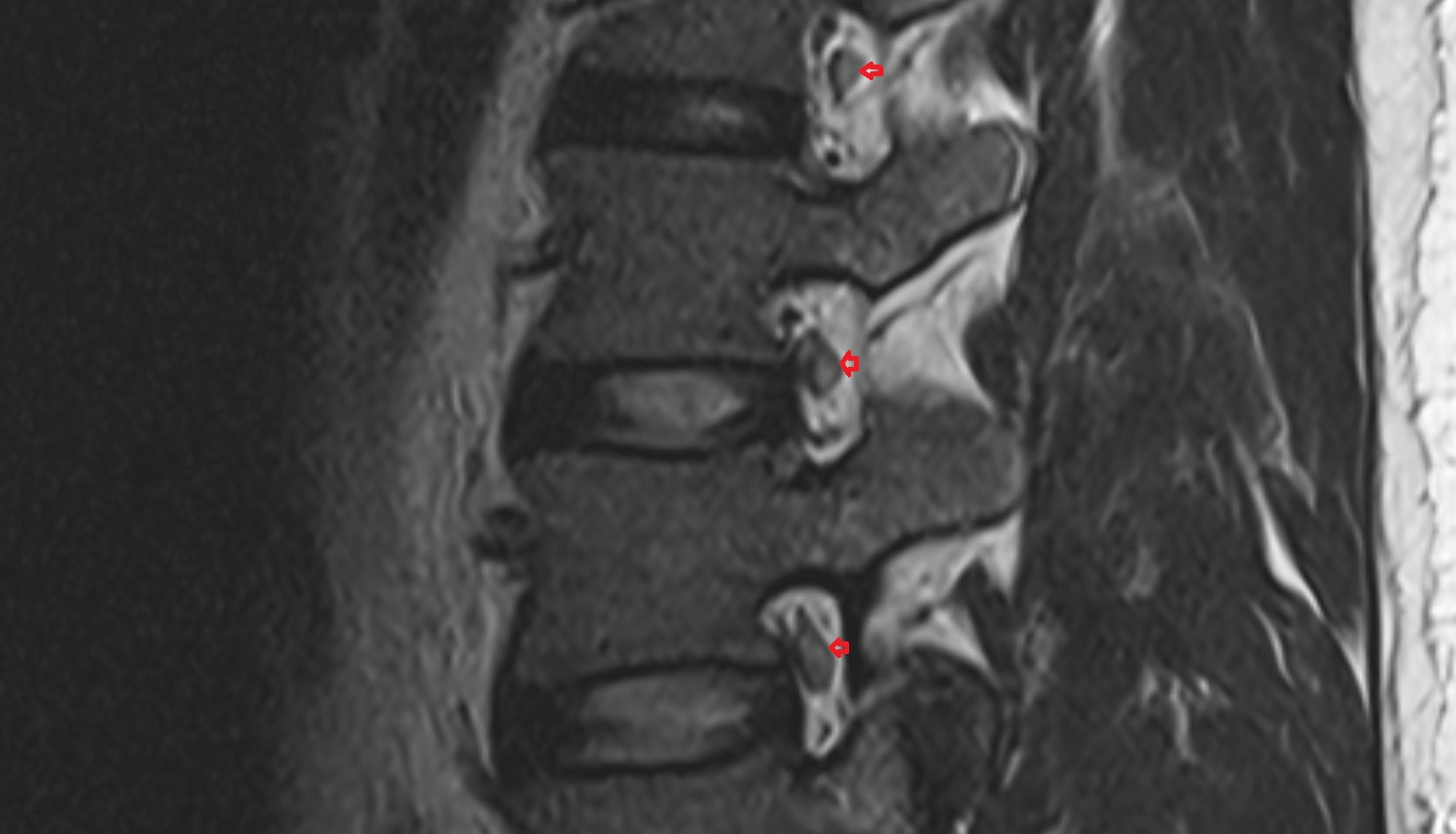 Dorsal root ganglion of spinal nerve  MRI sagittal  anatomy  image-img-00000-00000