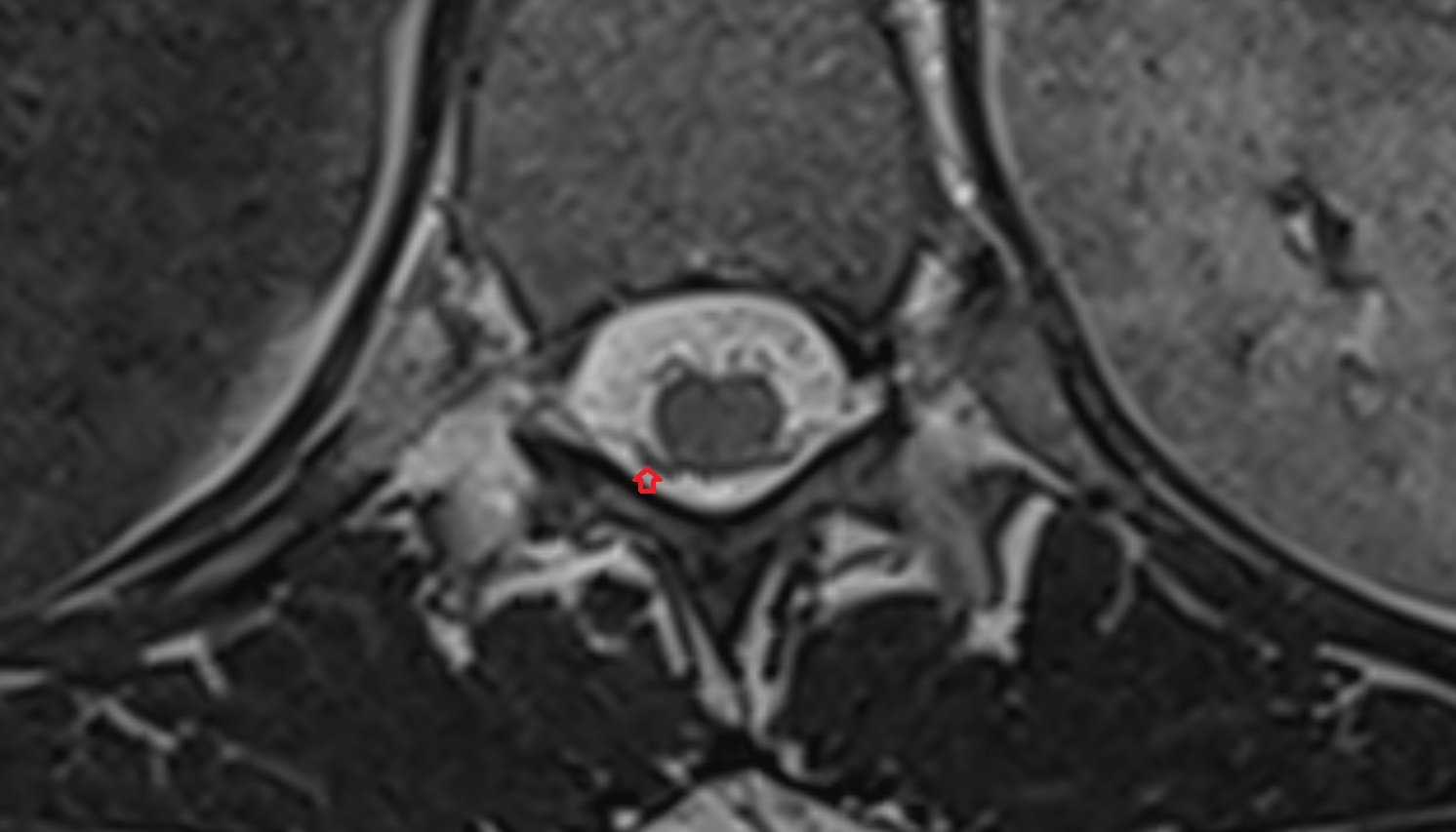 Dorsal root of spinal nerve  mri axial  image -img-00000-00000