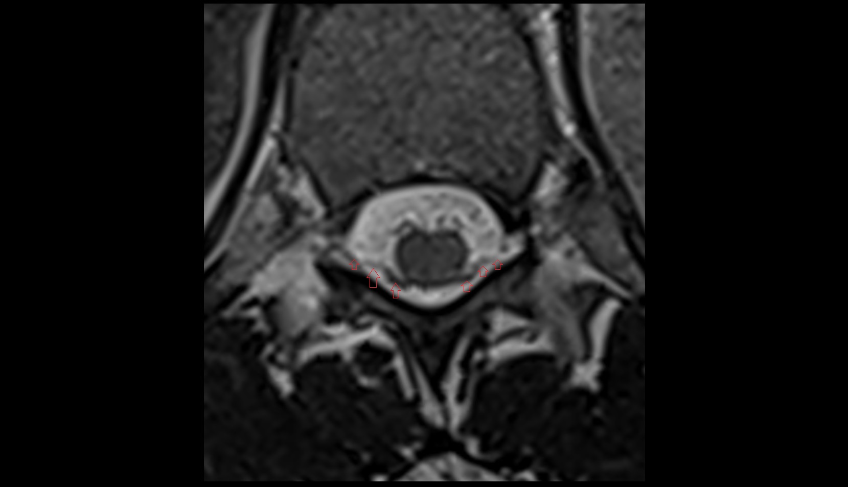 Dorsal root of spinal nerve mri axial image