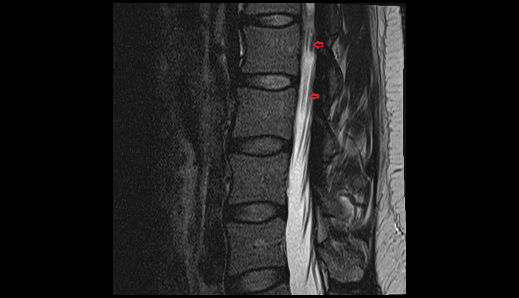 Dorsal root of spinal nerve mri sag image