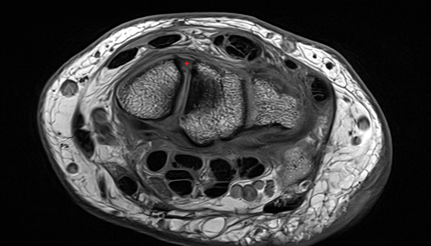 Dorsal scapholunate ligament axial cross sectional anatomy 3T MRI AI enhanced radiology image-img-00000-00000