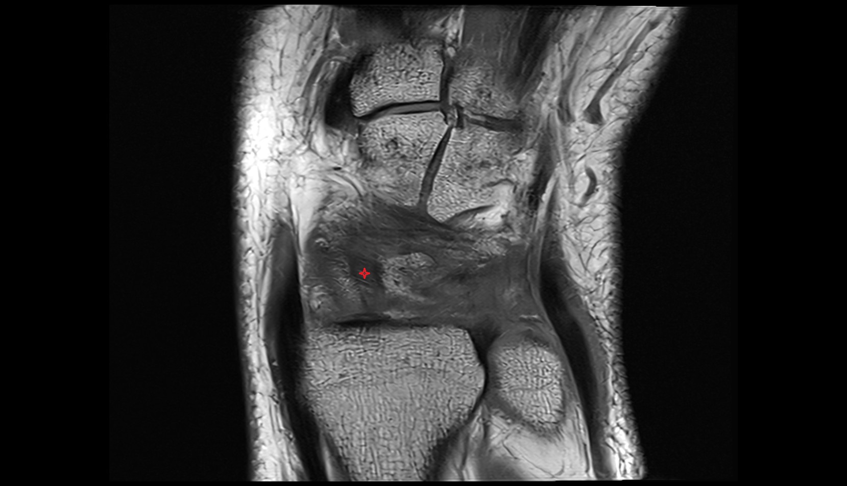 Dorsal scapholunate ligament mri coronal image
