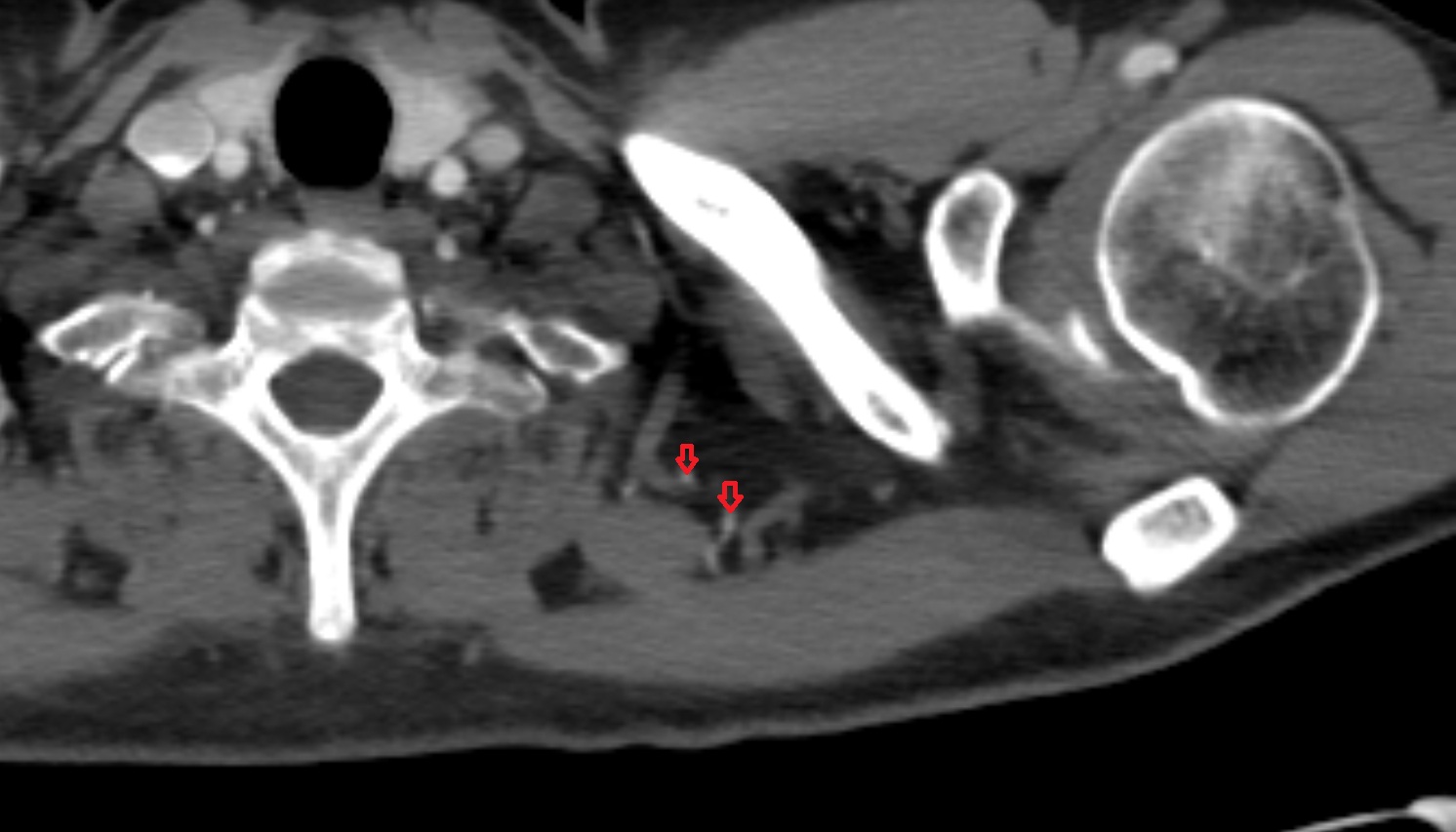 Dorsal scapular artery  anatomy CT axial  image -img-00000-00000