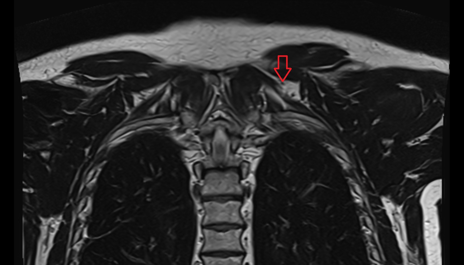 Dorsal scapular artery  anatomy MRI coronal  image -img-00000-00000