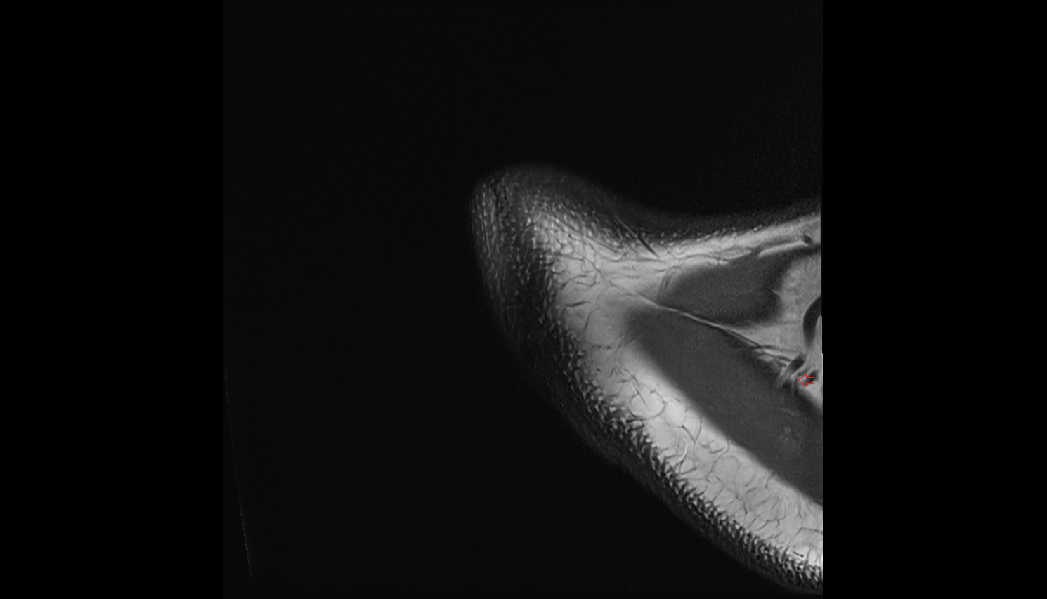 Dorsal scapular nerve axial cross sectional anatomy 3T MRI AI enhanced radiology image-img-00000-00000