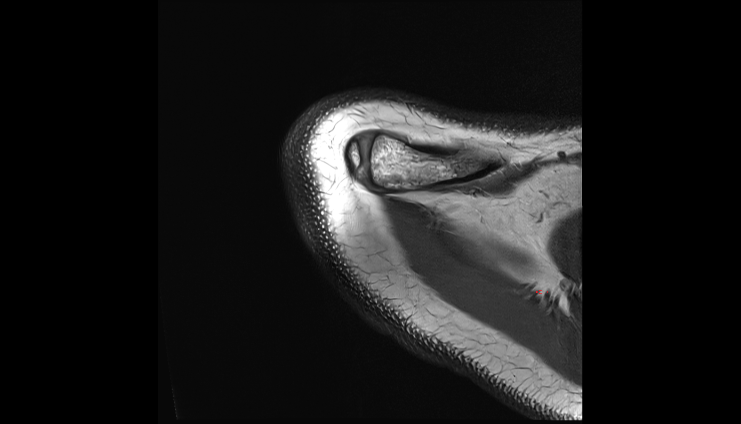 Dorsal scapular nerve axial cross sectional anatomy 3T MRI AI enhanced radiology image-img-00000-00000_00001