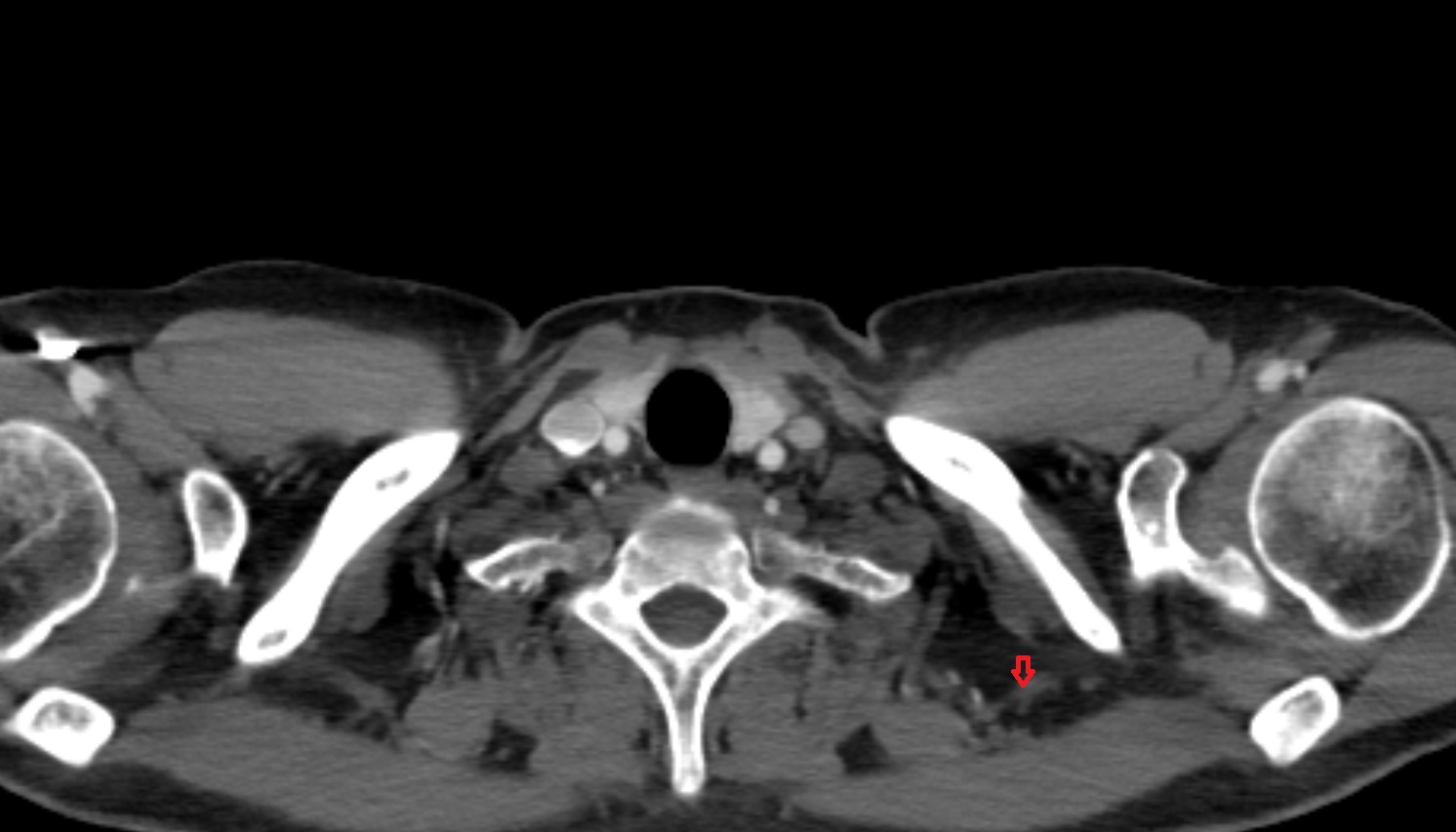 Dorsal scapular vein  CT axial  image -img-00000-00000