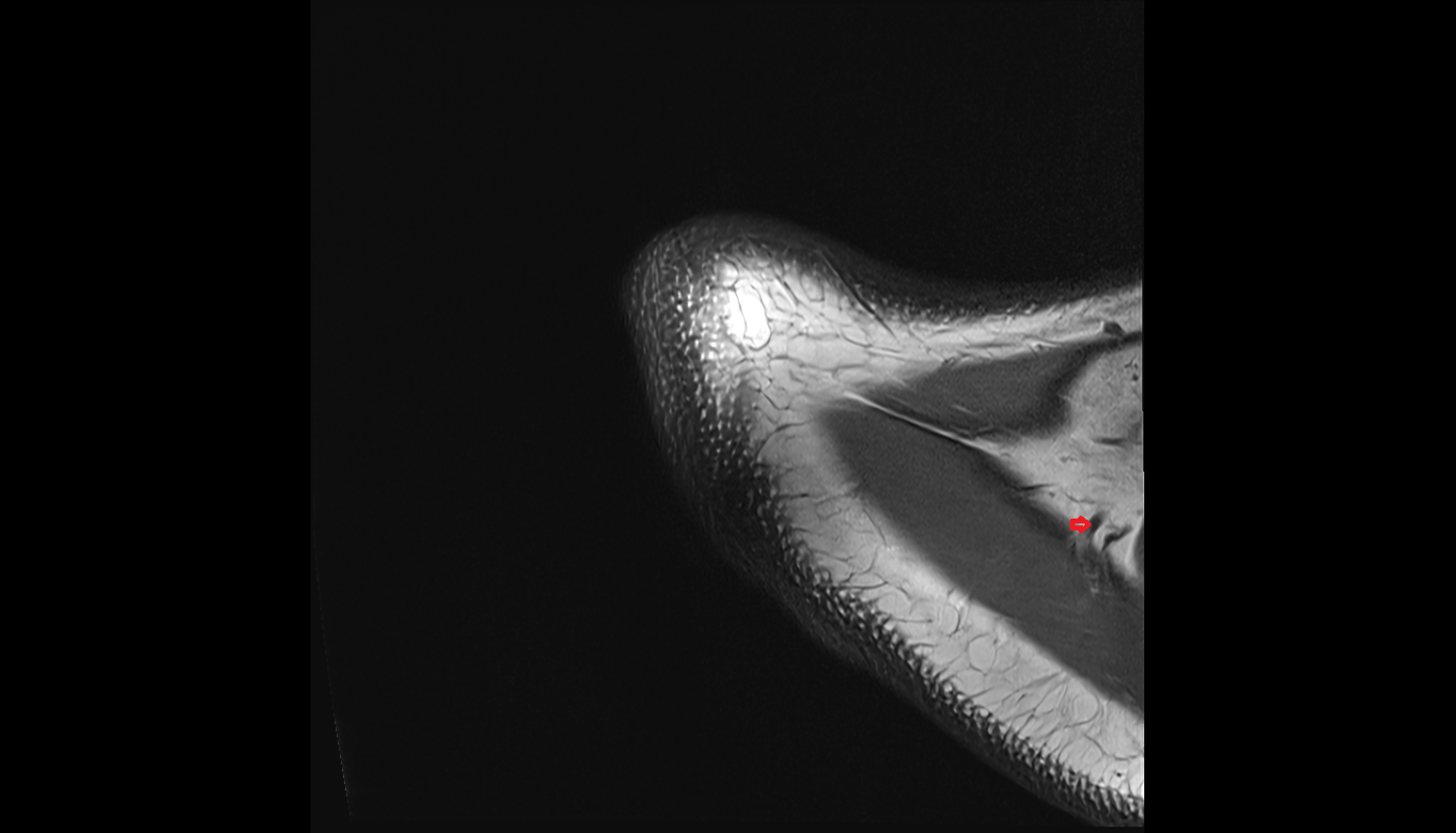 Dorsal scapular vein axial cross sectional anatomy 3T MRI AI enhanced radiology image-img-00000-00000