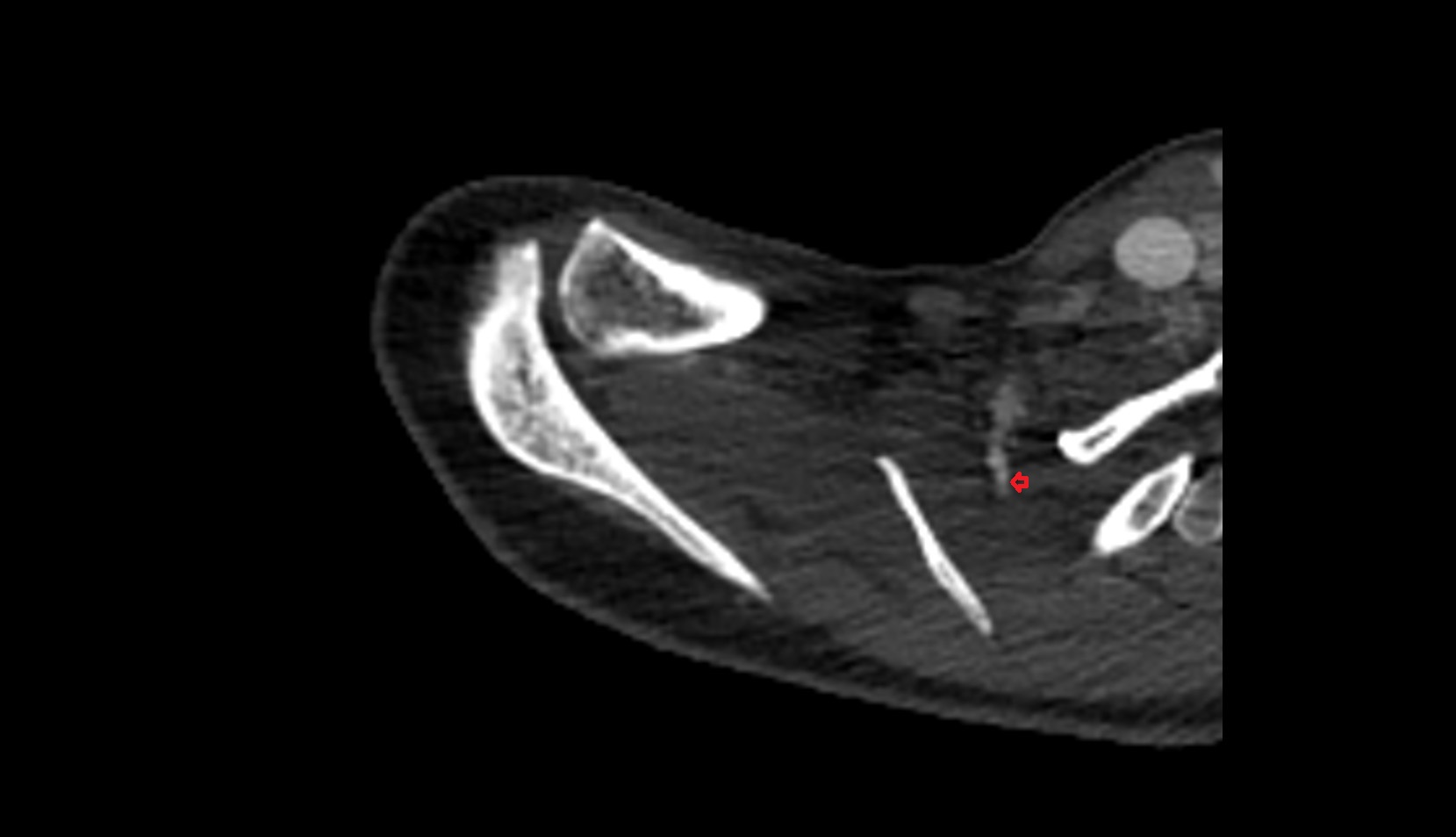Dorsal scapular vein ct axial