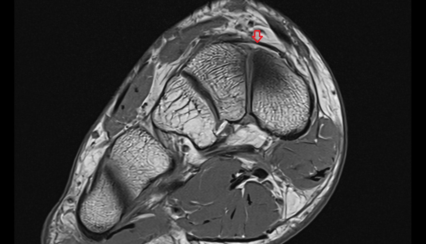 Dorsal talonavicular ligament coronal  cross sectional anatomy 3T MRI AI enhanced radiology image-img-00000-00000