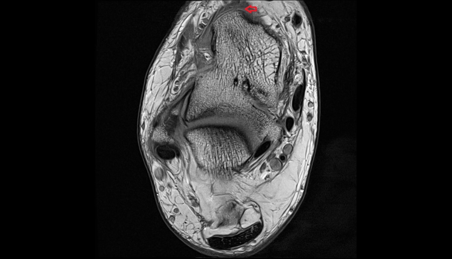 Dorsal talonavicular ligament coronal  cross sectional anatomy 3T MRI AI enhanced radiology image-img-00000-00000_00001
