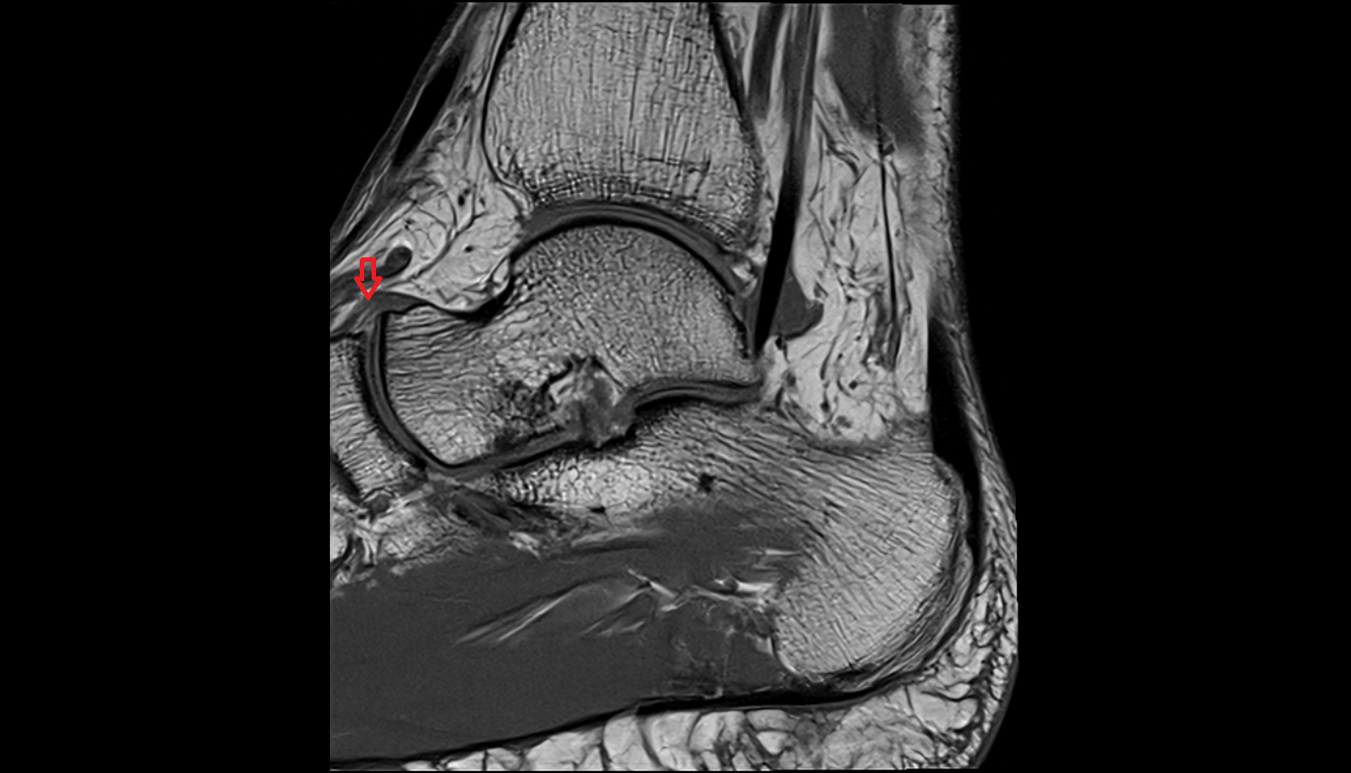 Dorsal talonavicular ligament sag  cross sectional anatomy 3T MRI AI enhanced radiology image-img-00000-00000_00002