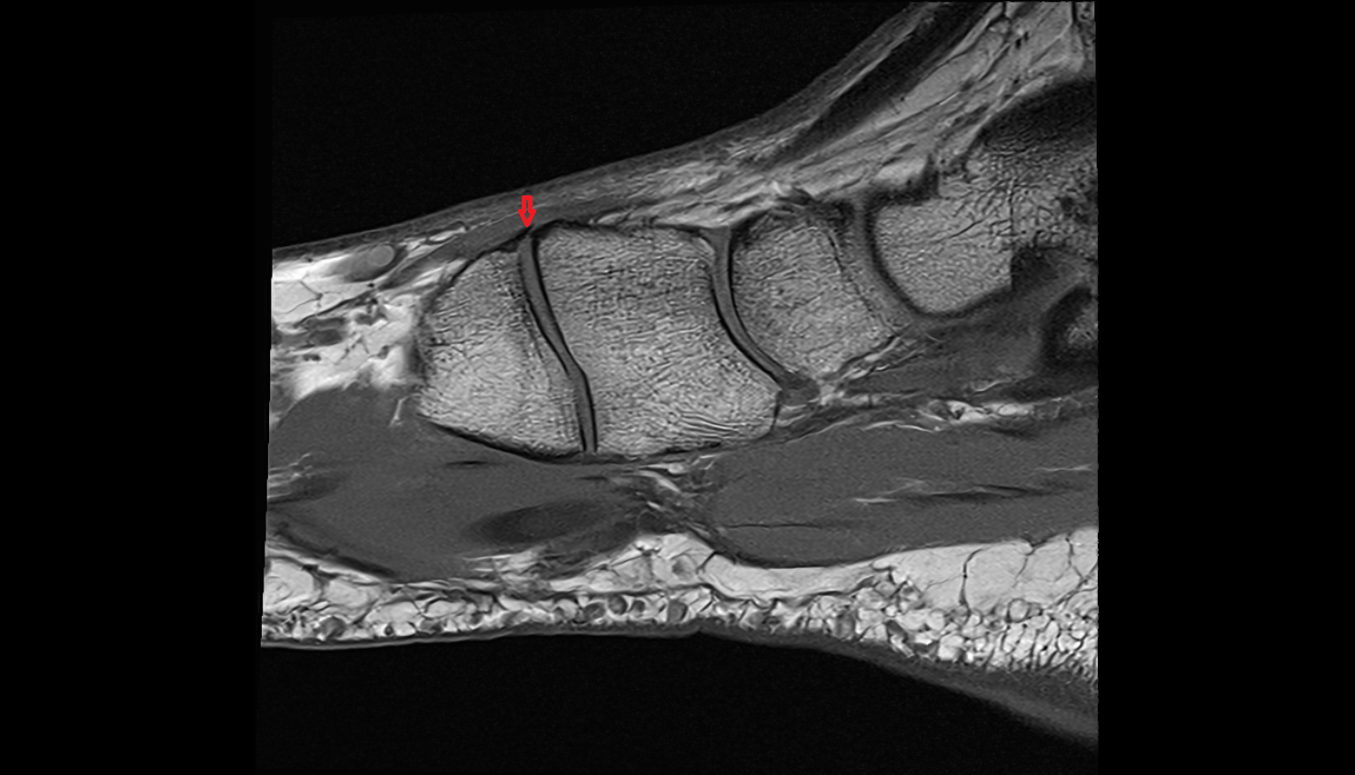 Dorsal tarsometatarsal ligaments  SAGITTAL cross sectional anatomy 3T MRI AI enhanced radiology image-img-00000-00000