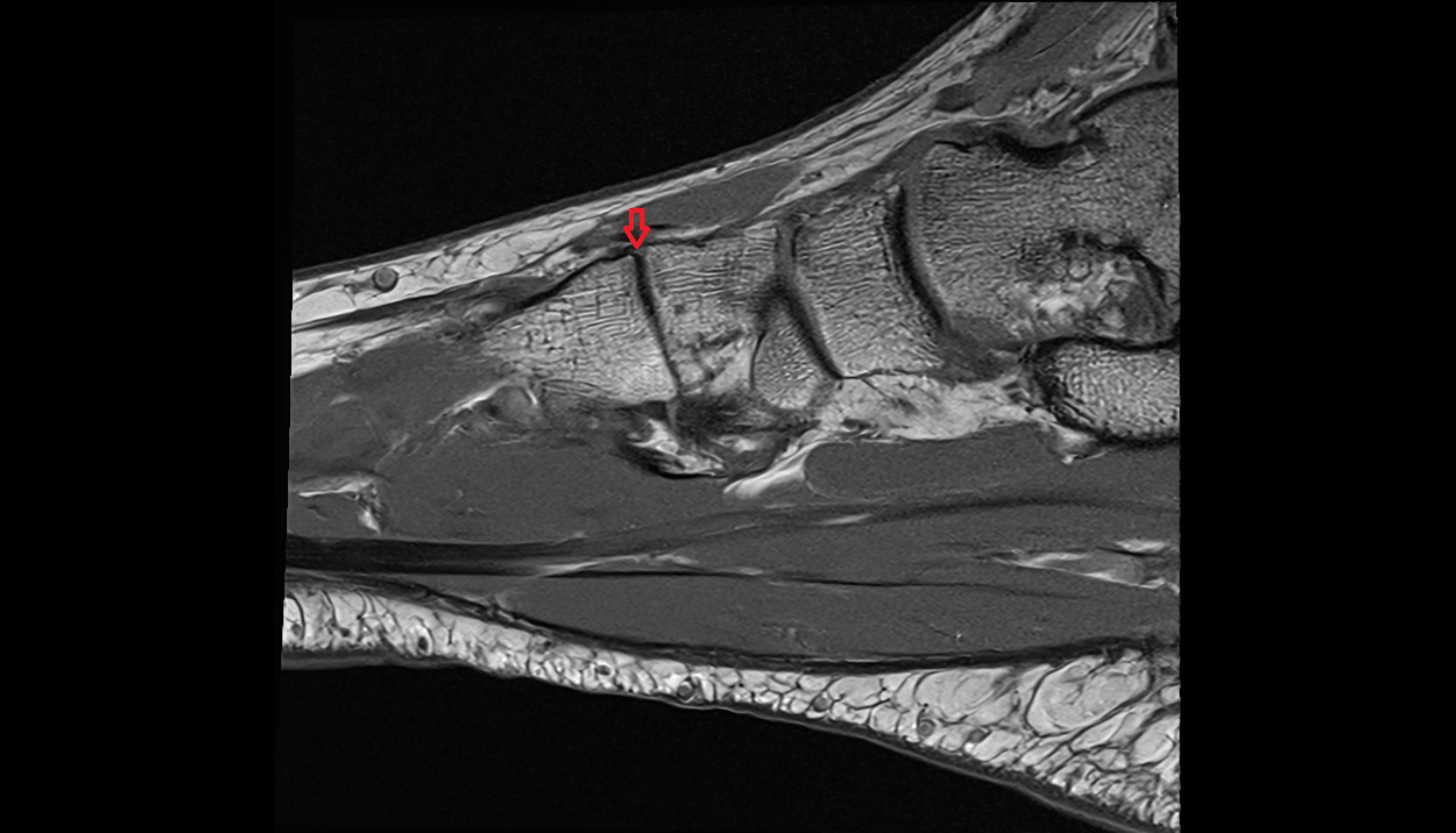 Dorsal tarsometatarsal ligaments  SAGITTAL cross sectional anatomy 3T MRI AI enhanced radiology image-img-00000-00000_00001