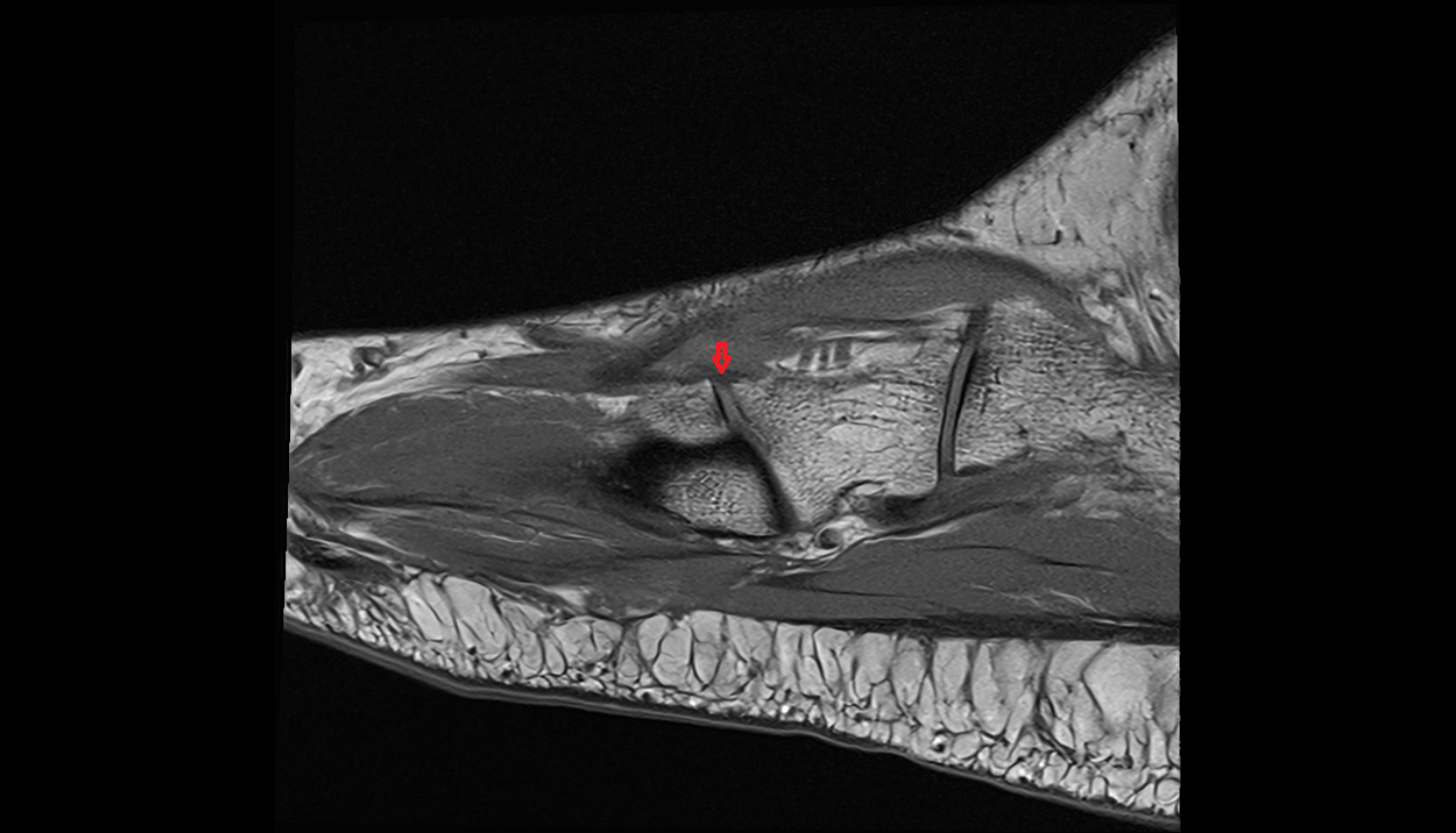 Dorsal tarsometatarsal ligaments  SAGITTAL cross sectional anatomy 3T MRI AI enhanced radiology image-img-00000-00000_00002
