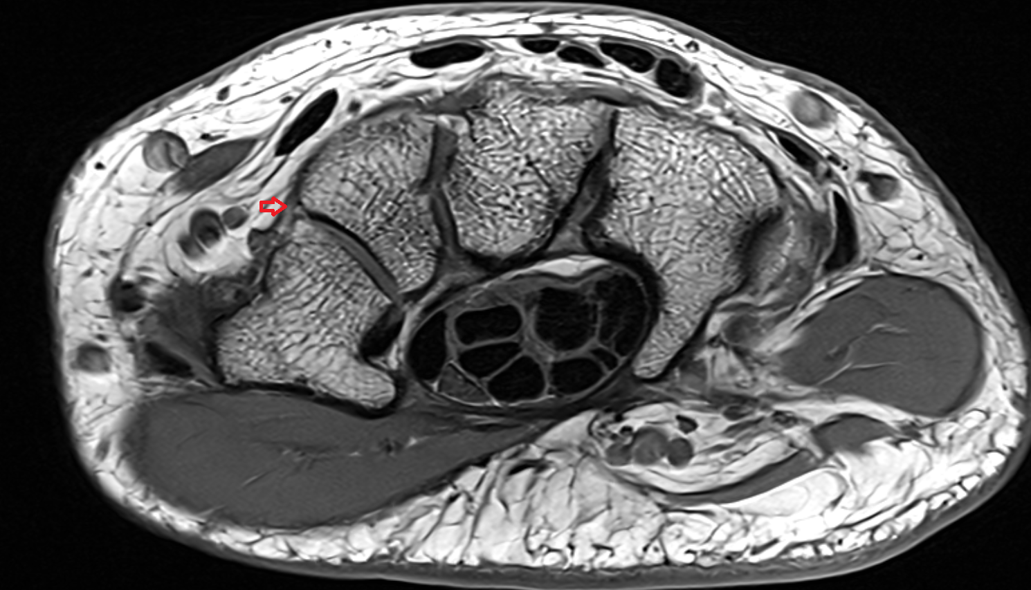 Dorsal trapeziotrapezoid ligament  axial cross sectional anatomy 3T MRI AI enhanced radiology image-img-00000-00000