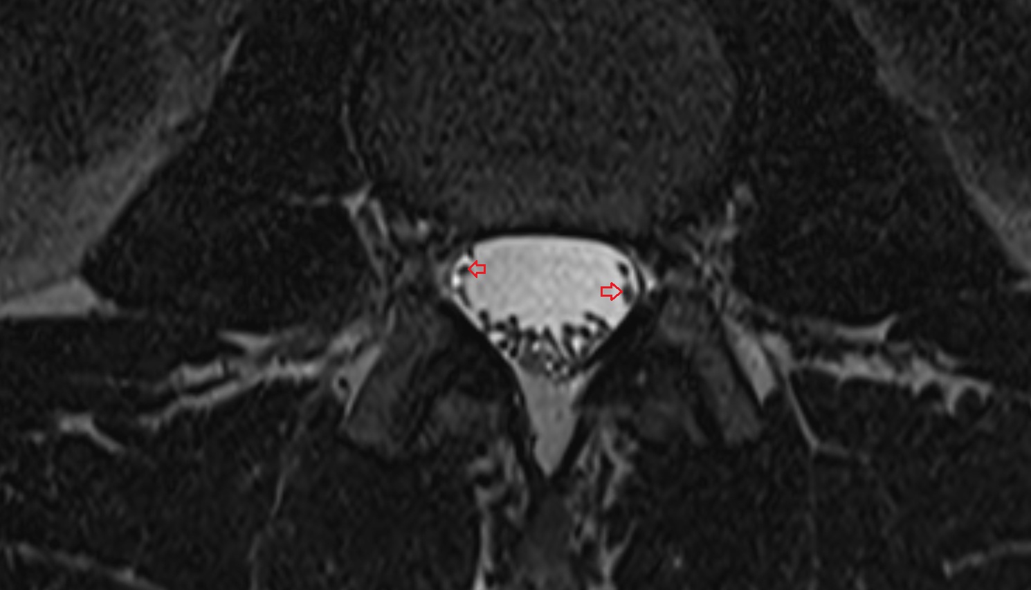 Dorsal traversing nerve root  MRI axial  anatomy  image