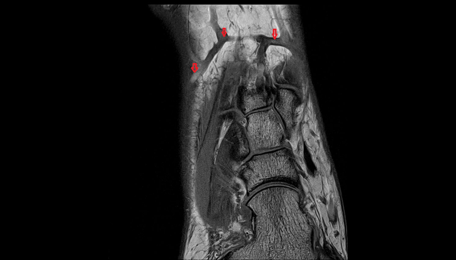 Dorsal venous arch of foot coronal cross sectional anatomy 3T MRI AI enhanced radiology image-img-00000-00000