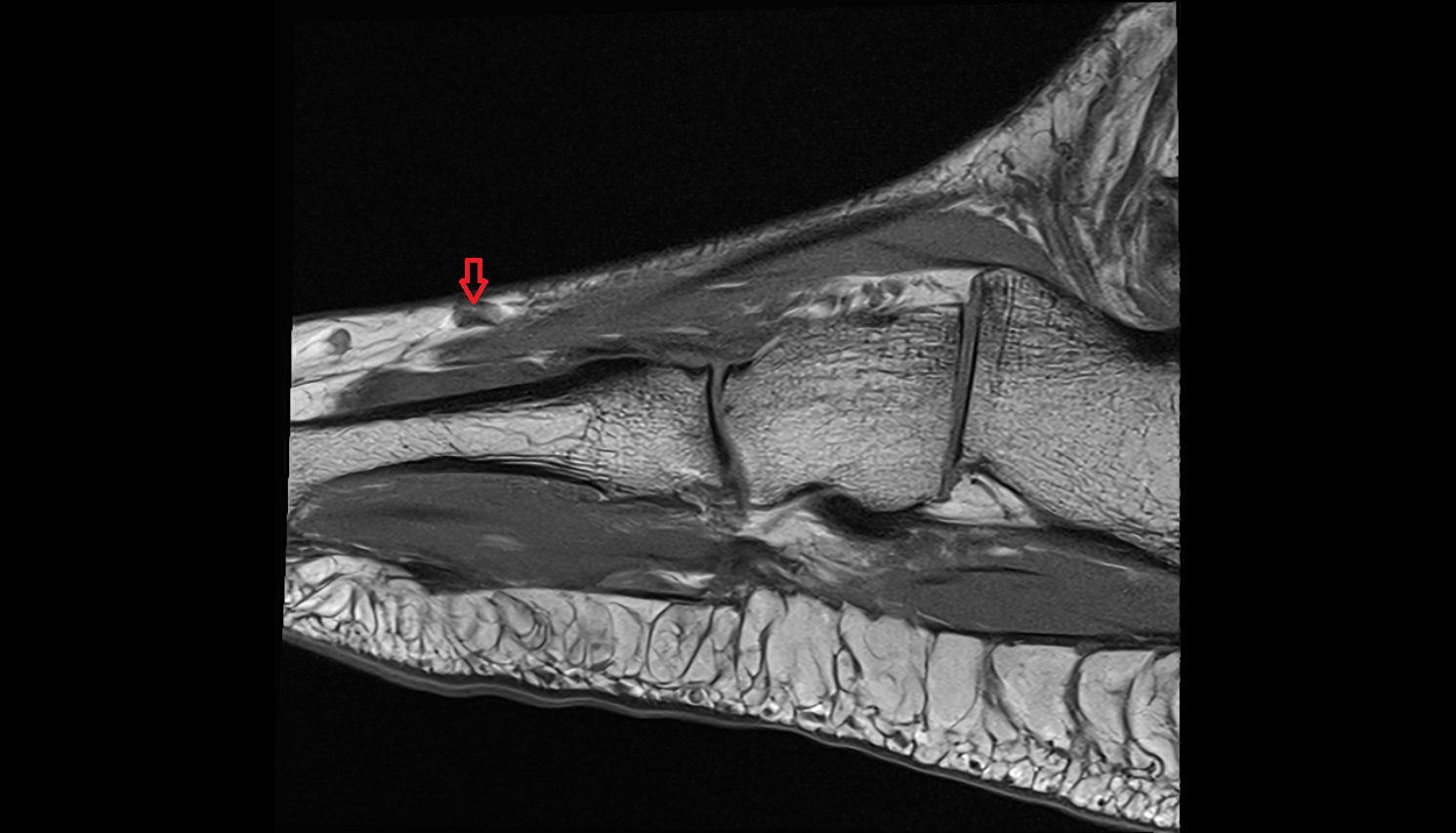 Dorsal venous arch of foot sag cross sectional anatomy 3T MRI AI enhanced radiology image-img-00000-00000