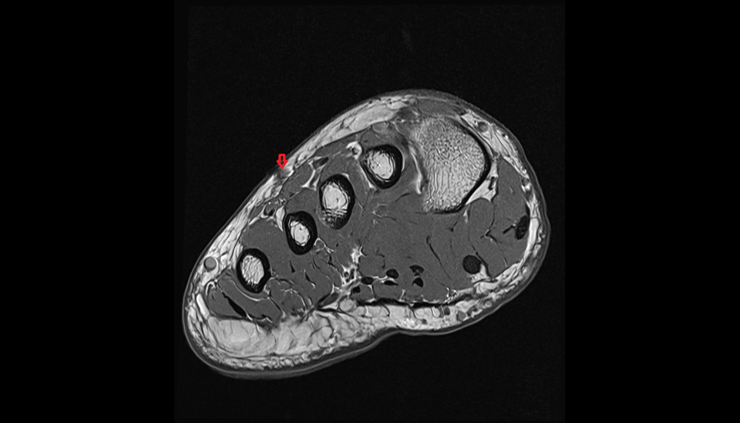 Dorsal venous arch of foot sag cross sectional anatomy 3T MRI AI enhanced radiology image-img-00000-00000_00001