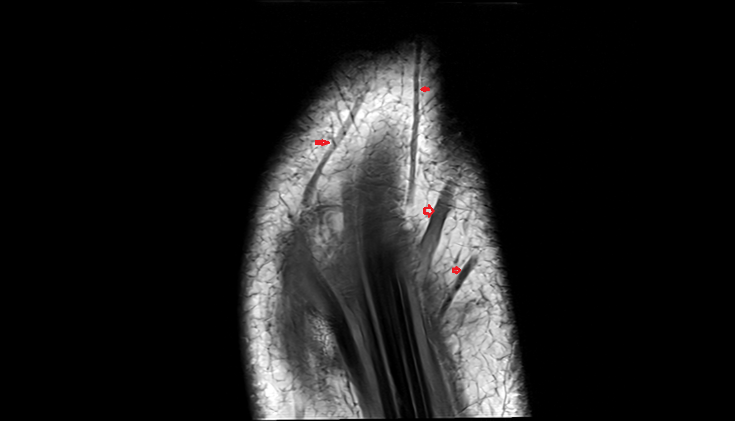 Dorsal venous network of hand  coronal cross sectional anatomy 3T MRI AI enhanced radiology image-img-00000-00000