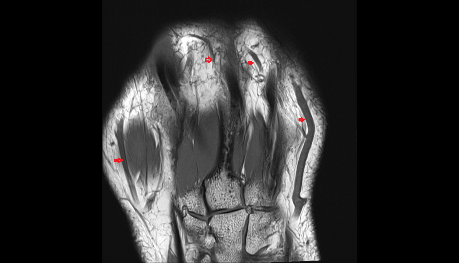 Dorsal venous network of hand  coronal cross sectional anatomy 3T MRI AI enhanced radiology image-img-00000-00000_00001
