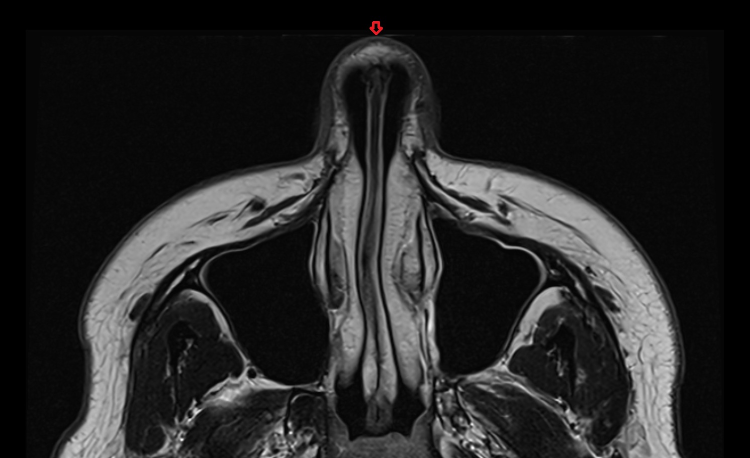 Dorsum of Nose mri axial image -img-00000-00000