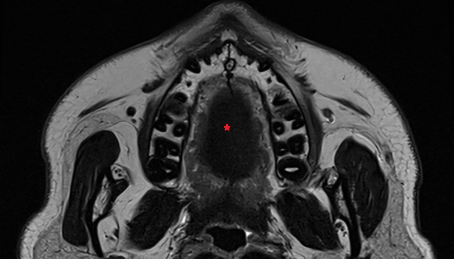 Dorsum of tongue mri axial  image -img-00000-00000