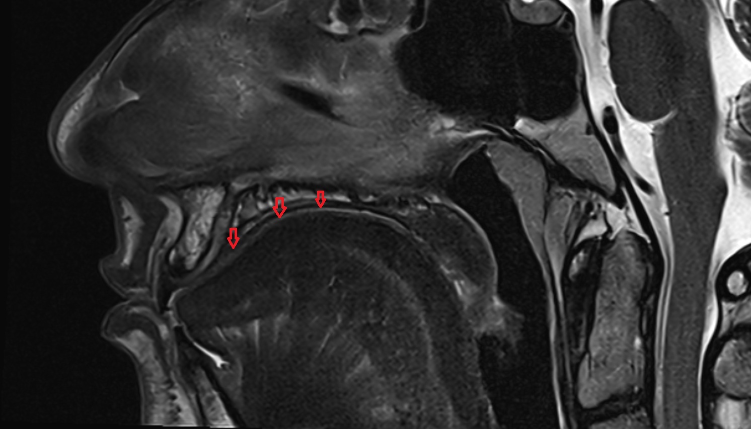 Dorsum of tongue mri sag  image -img-00000-00000