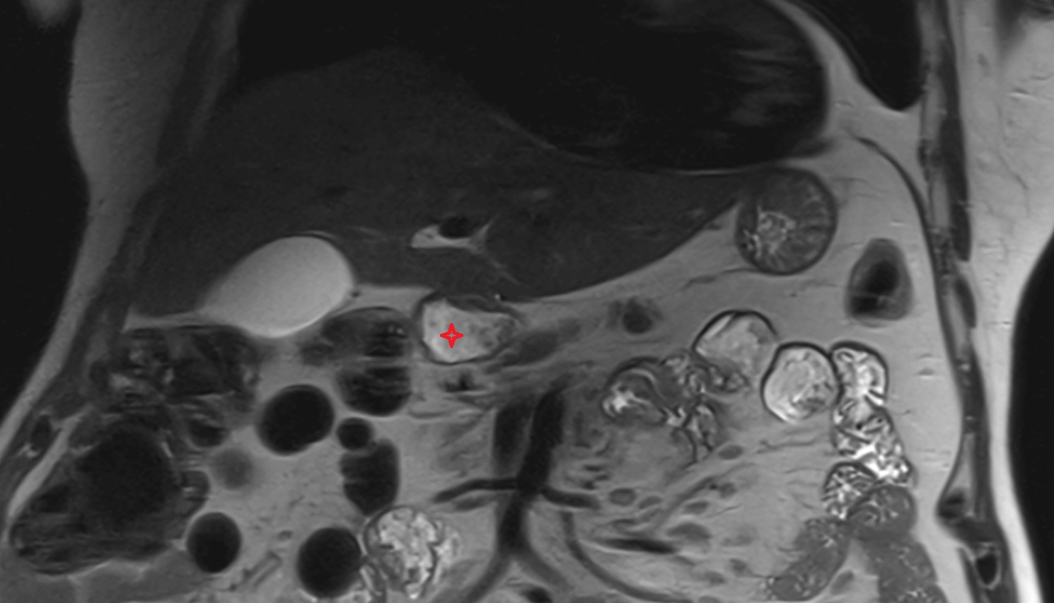 Duodenal bulb  MRI coronal anatomy  image-img-00000-00000