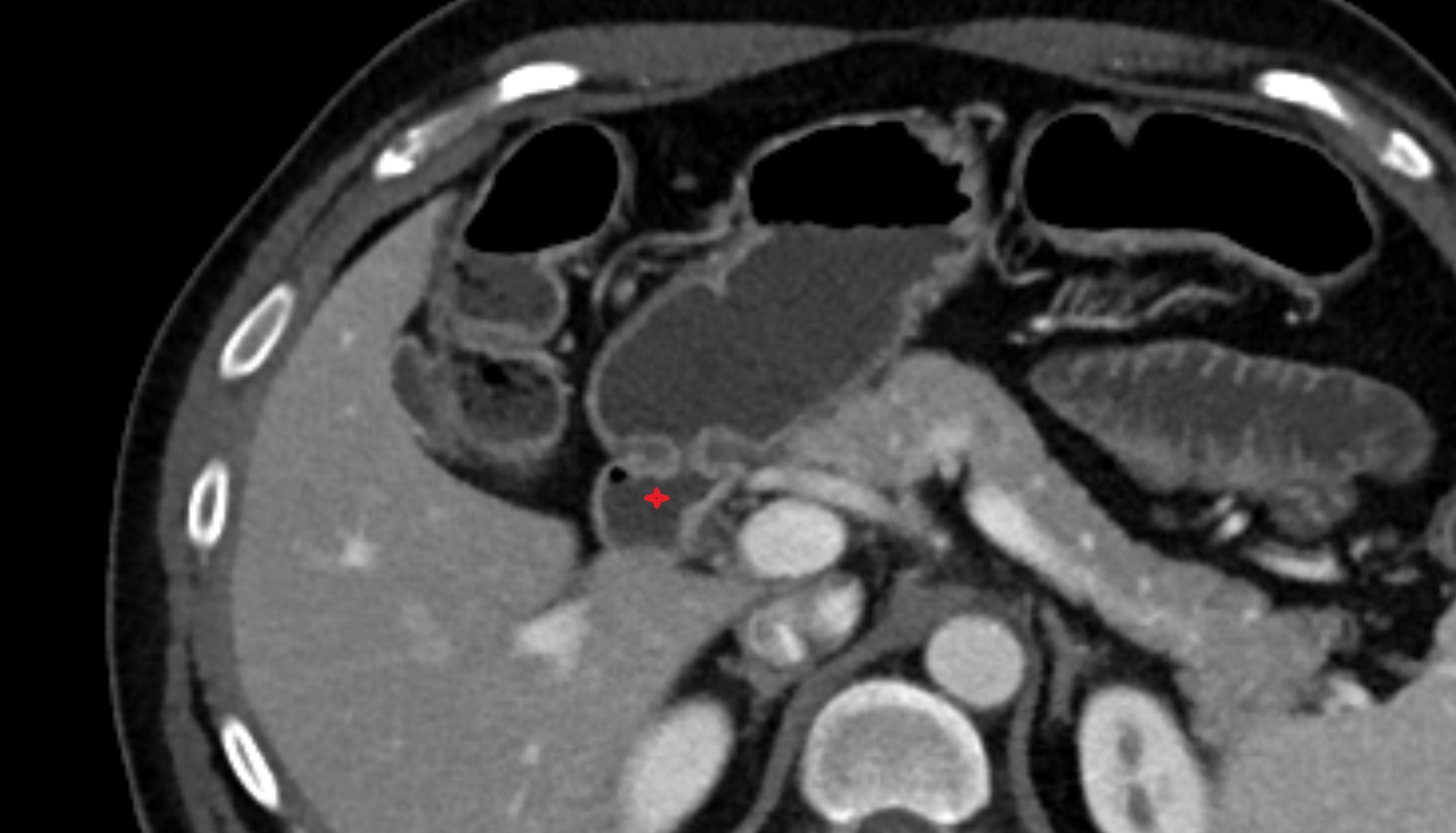Duodenal bulb  ct axial  anatomy  image-img-00000-00000