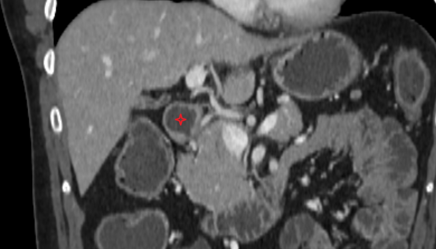 Duodenal bulb  ct coronal anatomy  image-img-00000-00000