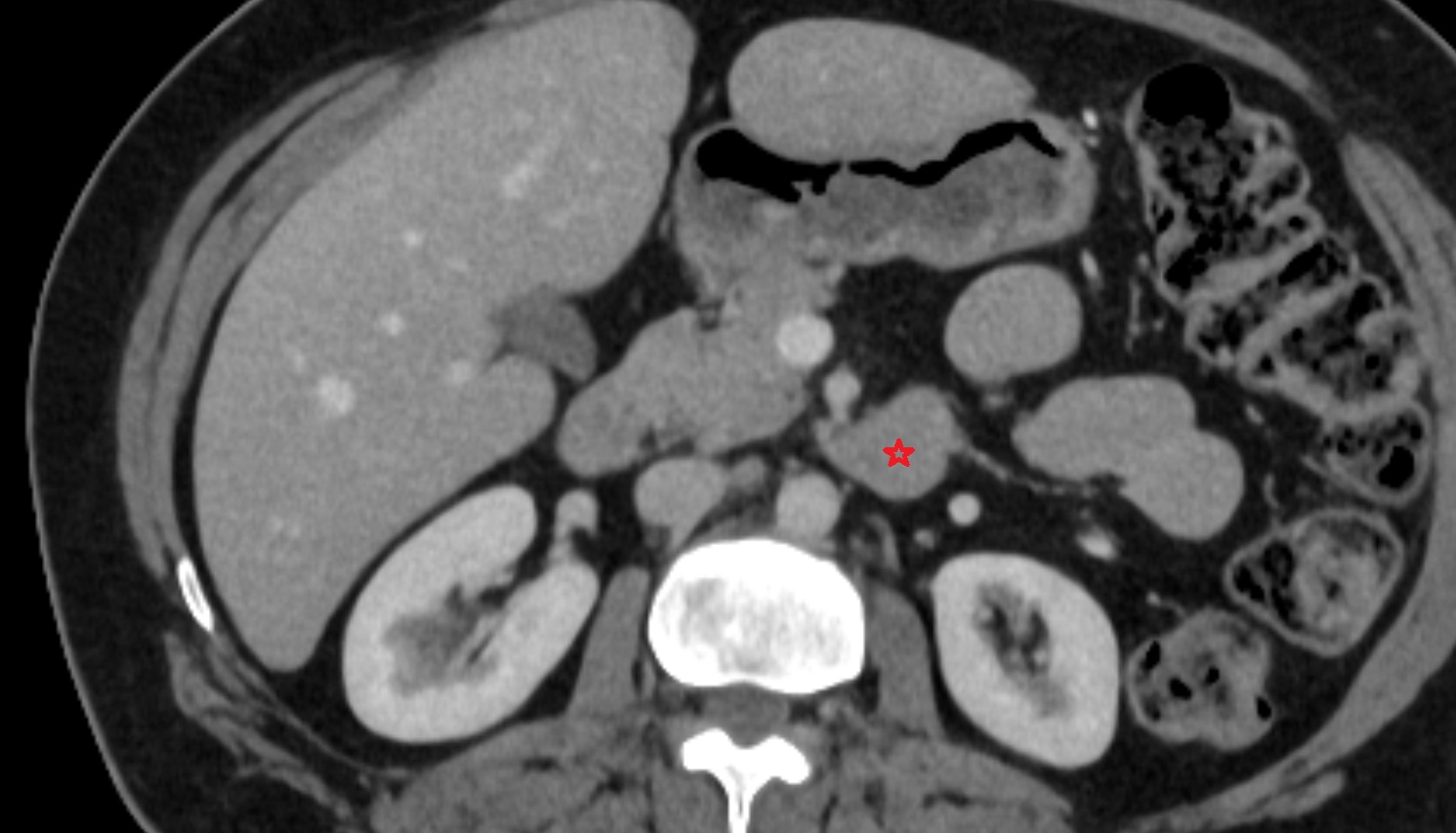 Duodenum – Ascending part (D4)   CT axial  anatomy  image -img-00000-00000