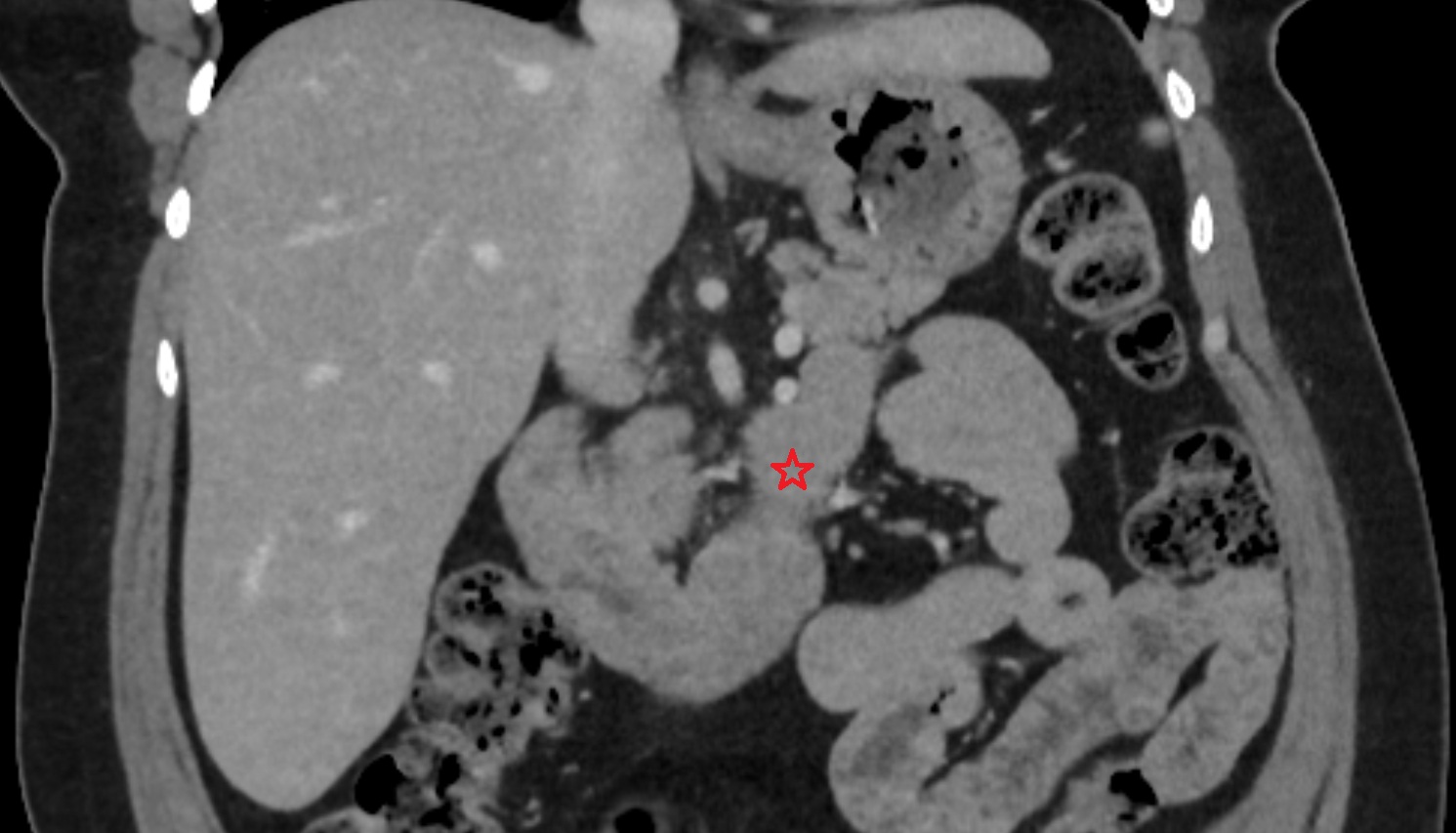 Duodenum – Ascending part (D4)   CT axiall  anatomy  image -img-00000-00000