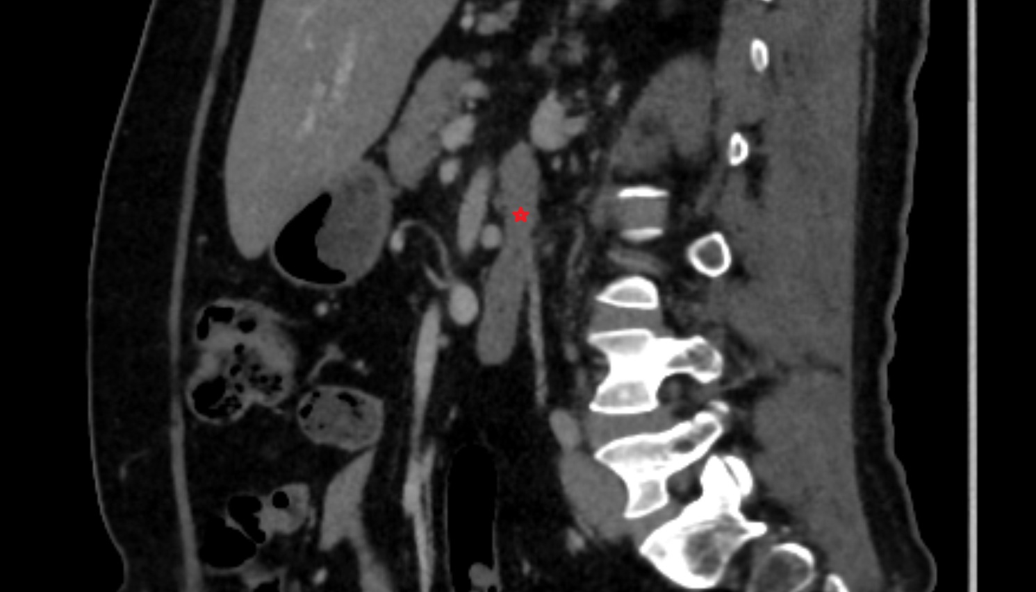 Duodenum – Ascending part (D4)   CT sag  anatomy  image -img-00000-00000