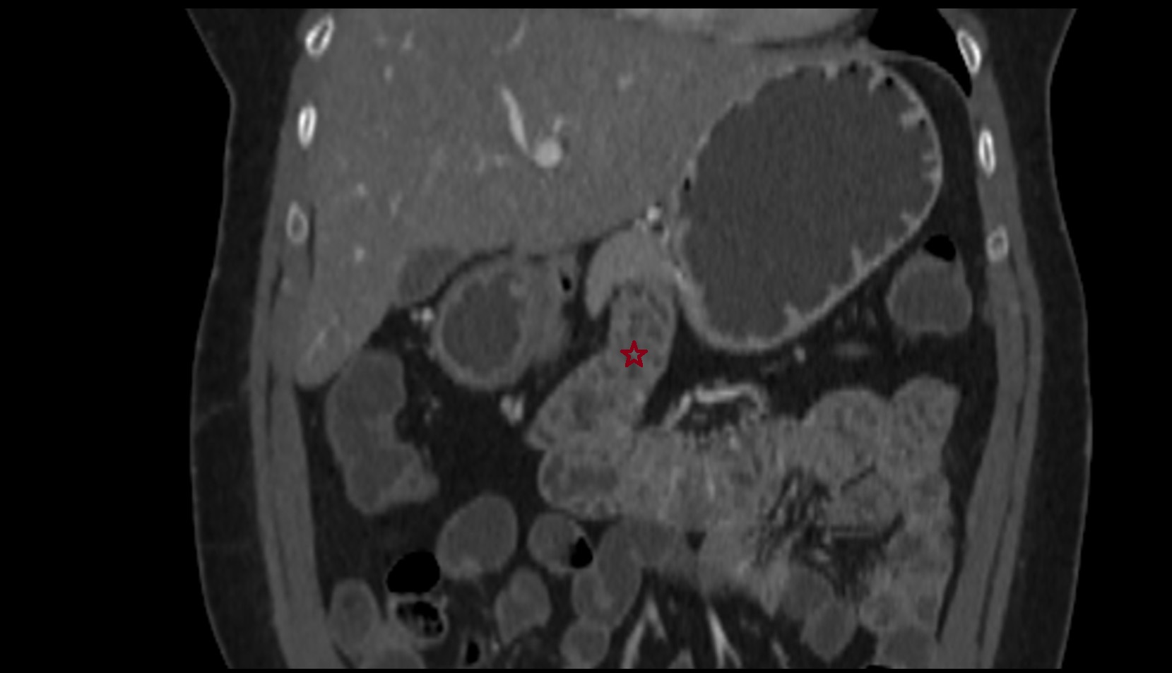 Duodenum – Ascending part (D4) ct coronal image