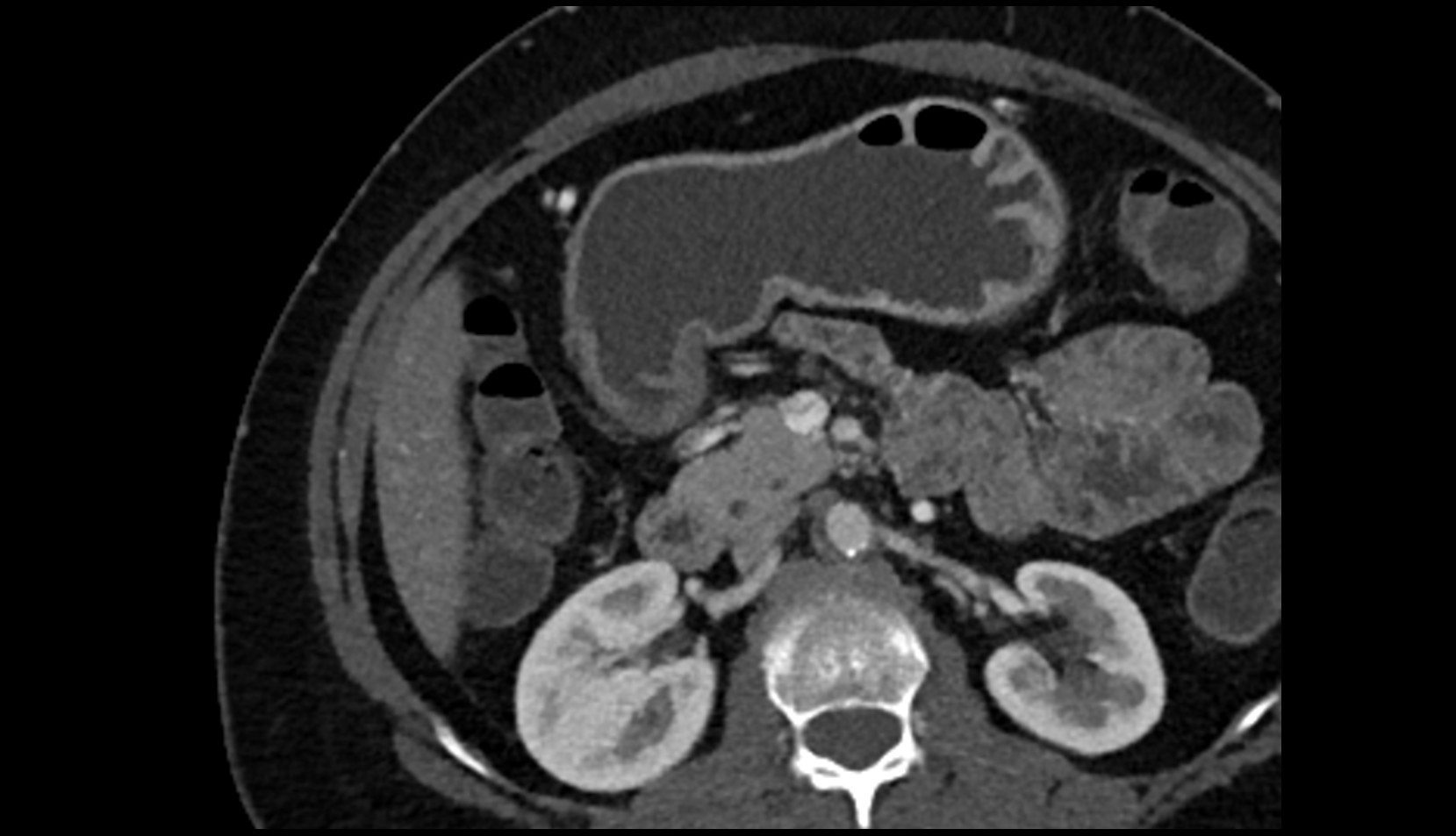 Duodenum – Descending part (D2) CT axial image