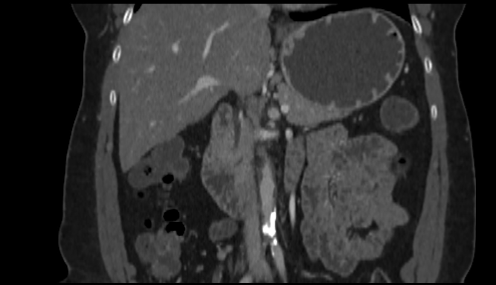 Duodenum – Descending part (D2) CT  coronal image