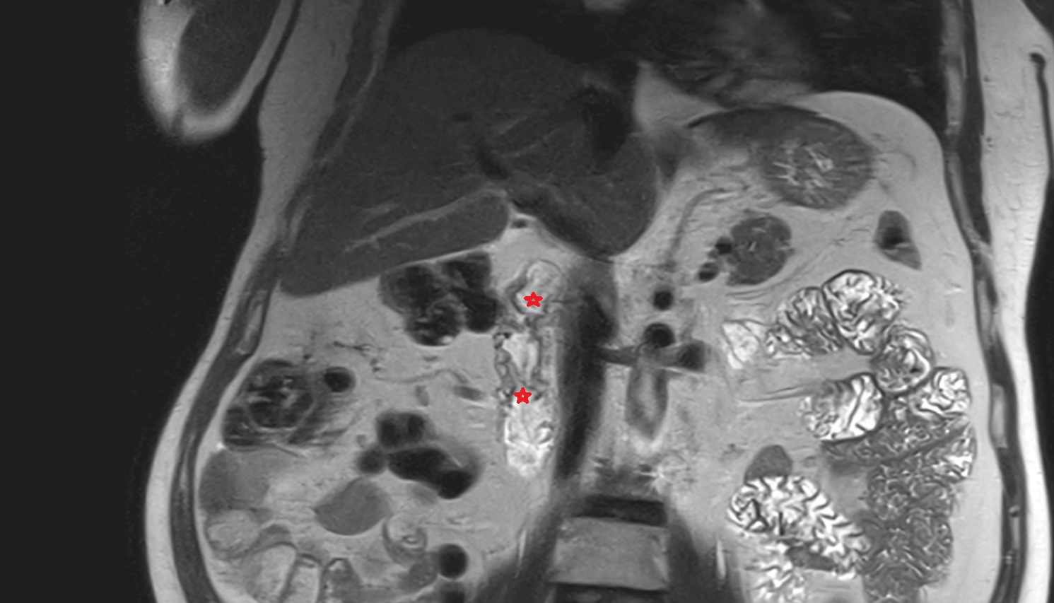 Duodenum – Descending part (D2)   MRI coronal  anatomy  image -img-00000-00000