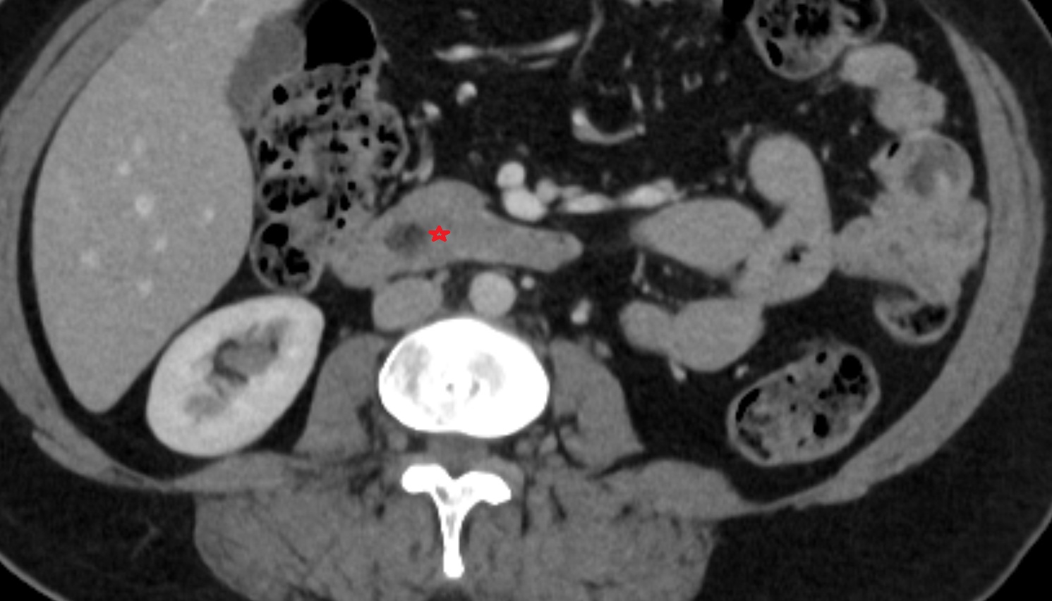 Duodenum – Horizontal part (D3)   CT axiall  anatomy  image -img-00000-00000