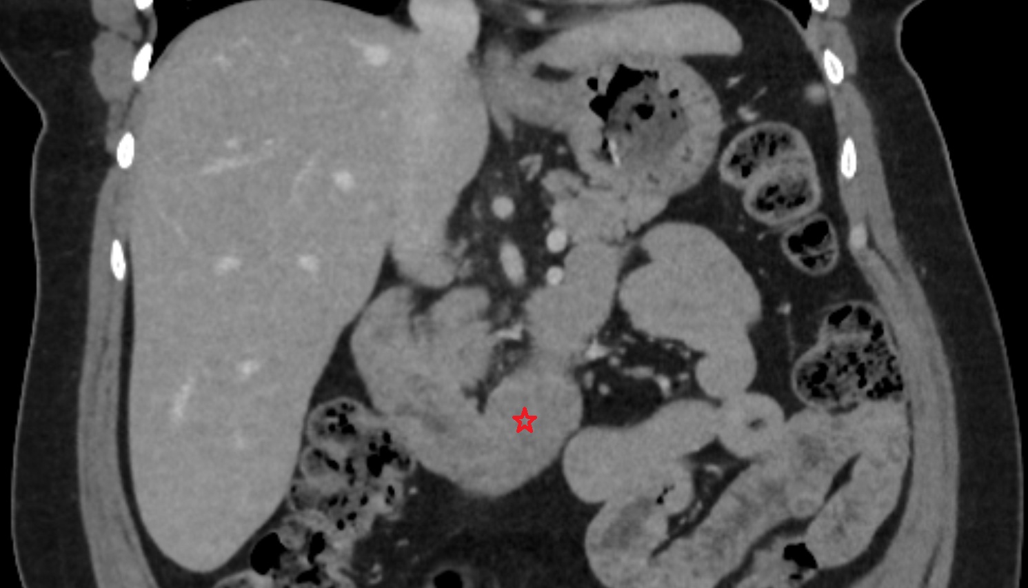 Duodenum – Horizontal part (D3)   CT axiall  anatomy  image -img-00000-00000_00001